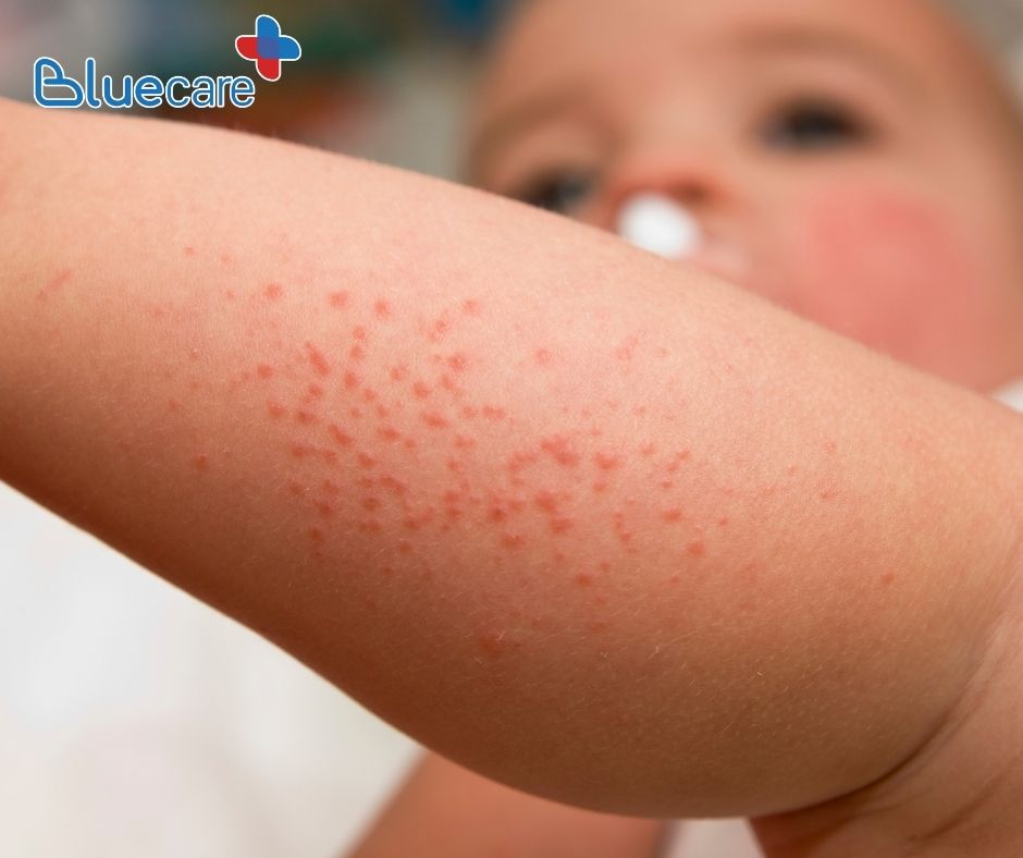 Rôm sảy ở trẻ sơ sinh