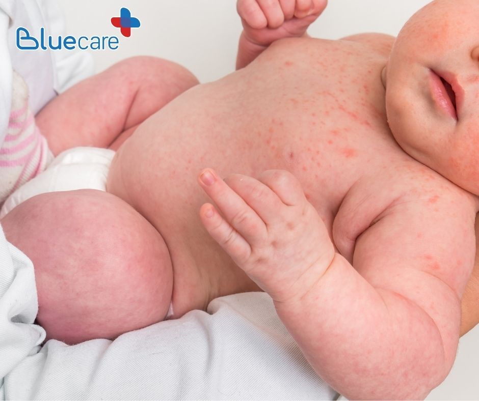 Những loại rôm sảy thường gặp ở trẻ